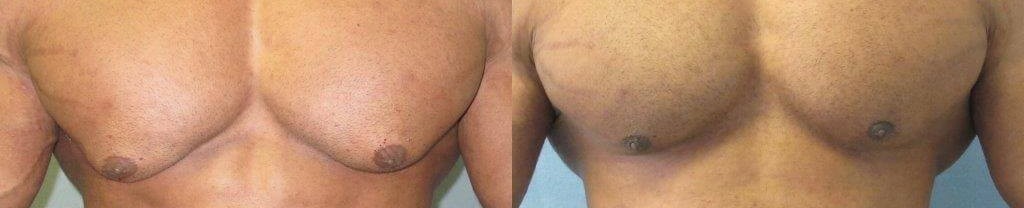 Gynecomastia comparstion of two pictures